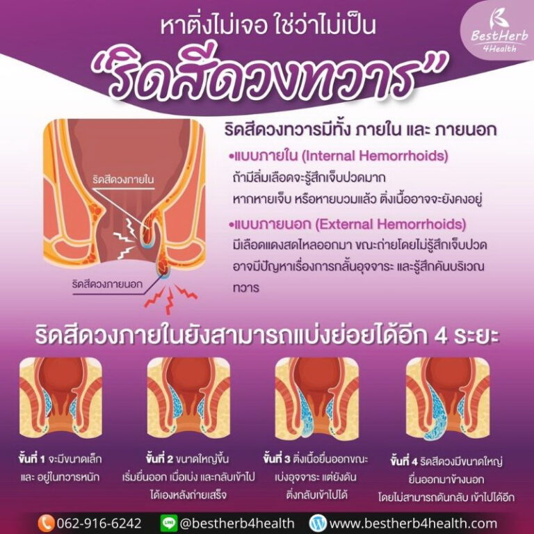 ริดสีดวงทวาร ชนิดภายใน และภายนอก ริดจิ สมุนไพรแก้ปัญหาตรงจุดที่เป็น