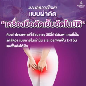 ริดสีดวงทวารแบบผ่าตัดด้วยเครื่องมือตัดเย็บอัตโนมัติ